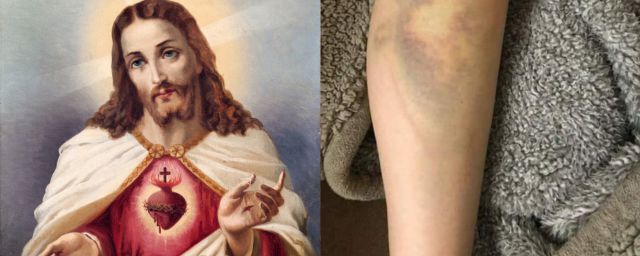 ¿Milagro de Semana Santa? Joven se cae y le sale un morado en forma de Sagrado Corazón de Jesús