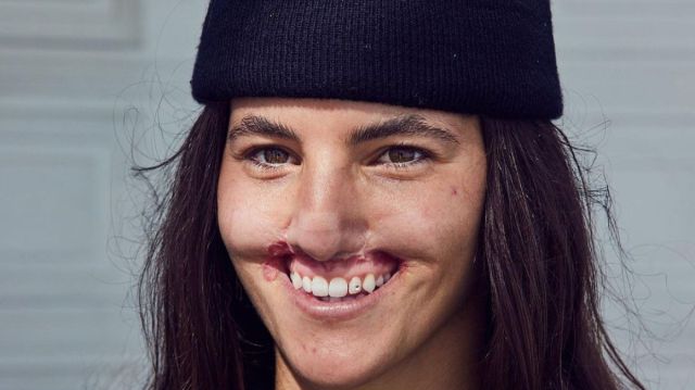 La skateboarder a la que la mordida de un perro en su boca le cambió la vida